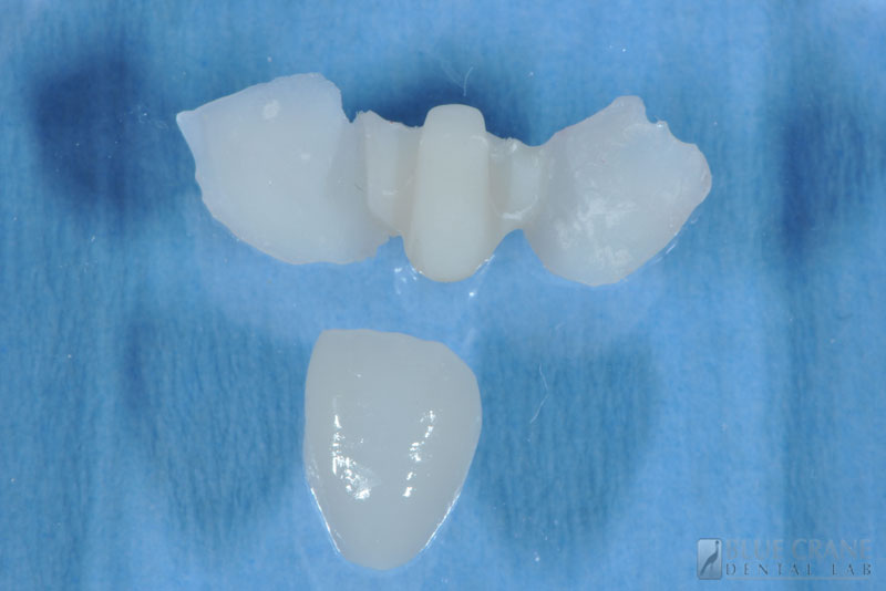Provisionals Blue Crane Dental Lab