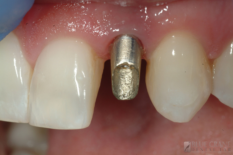 implants abutment dental cast procedure abutments lab screw