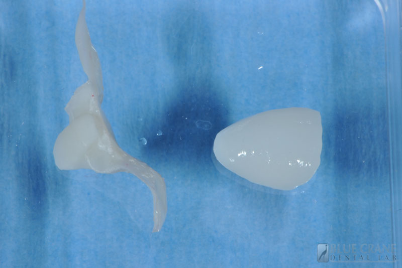 Provisionals Blue Crane Dental Lab