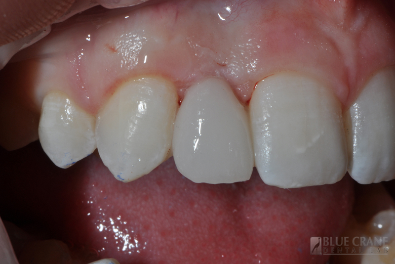 Provisionals Blue Crane Dental Lab