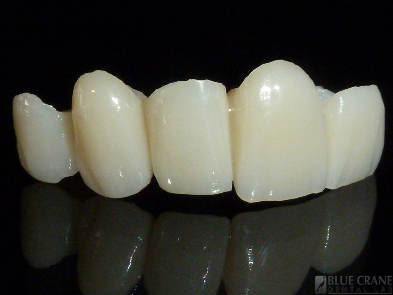 Provisionals Blue Crane Dental Lab