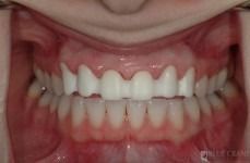 Zirconium frame - Before