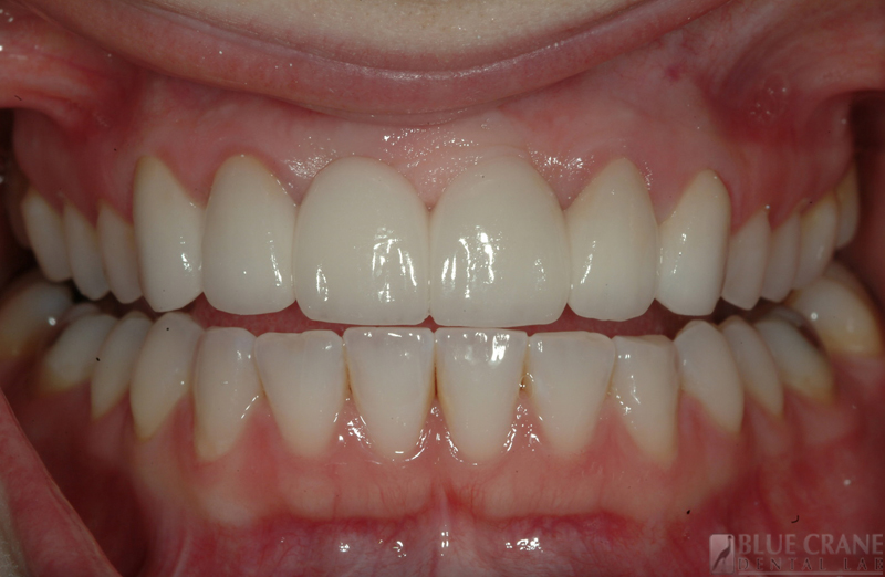 Zirconium Frames Blue Crane Dental Lab