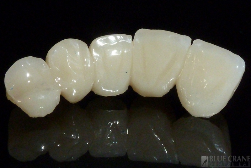 dental provisional bridge lab provisionals procedure maryland