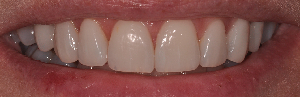 Dental Provisionals