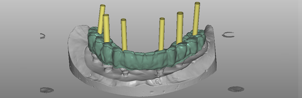 Dental Implants