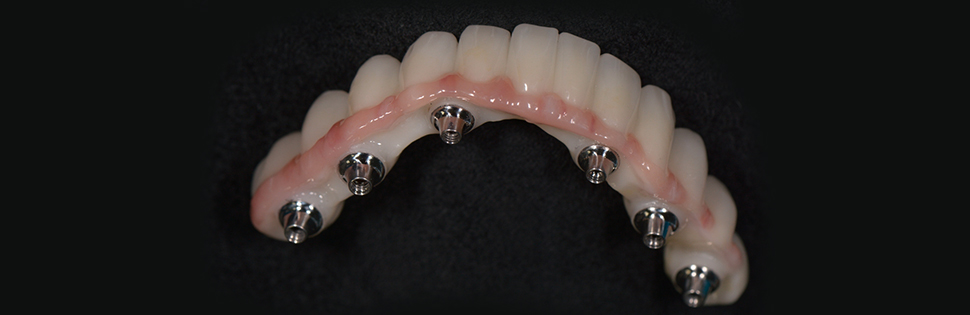 Dental Implant on Wax-up