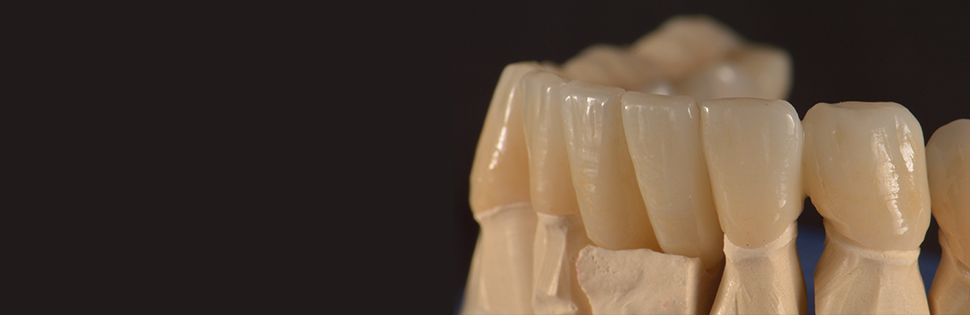 Dental Implant on Wax-up
